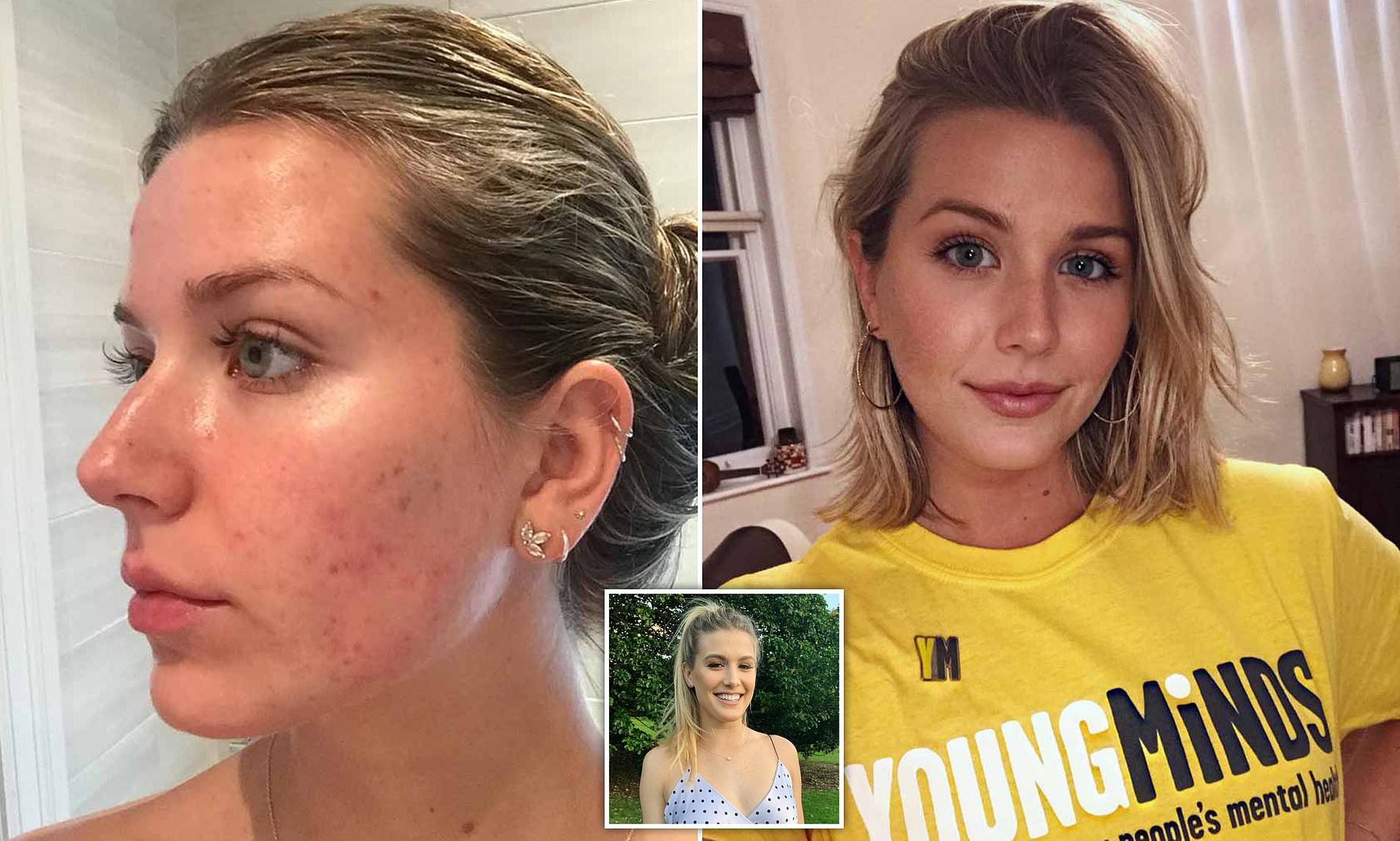 Why Do Female Tennis Players Have Acne